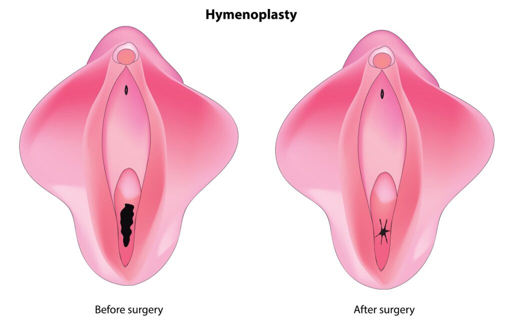 himenoplastie