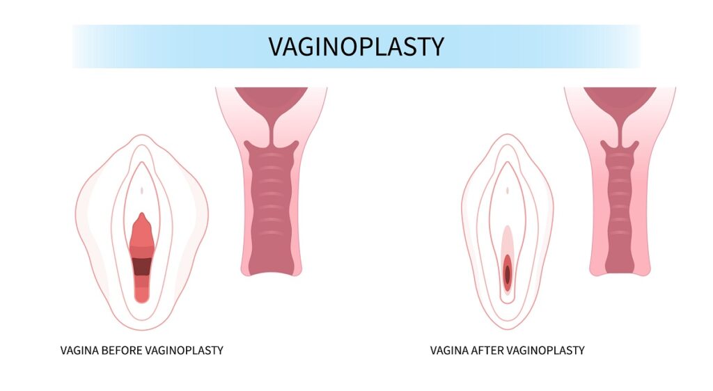 vaginoplastie